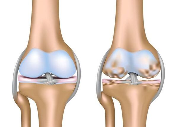 Arthrose