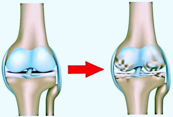 Normales Kniegelenk und durch Arthrose beeinflusst