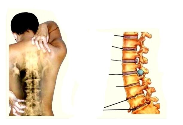 Entwicklungsstadien der Osteochondrose