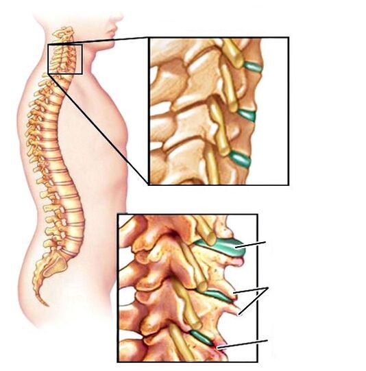 Gesunde Wirbelsäule und beschädigte Osteochondrose