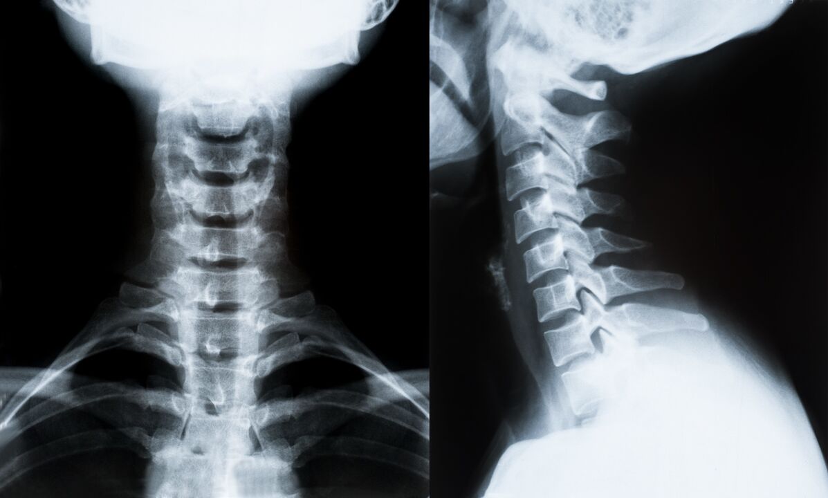 zervikale Osteochondrose im Röntgenbild